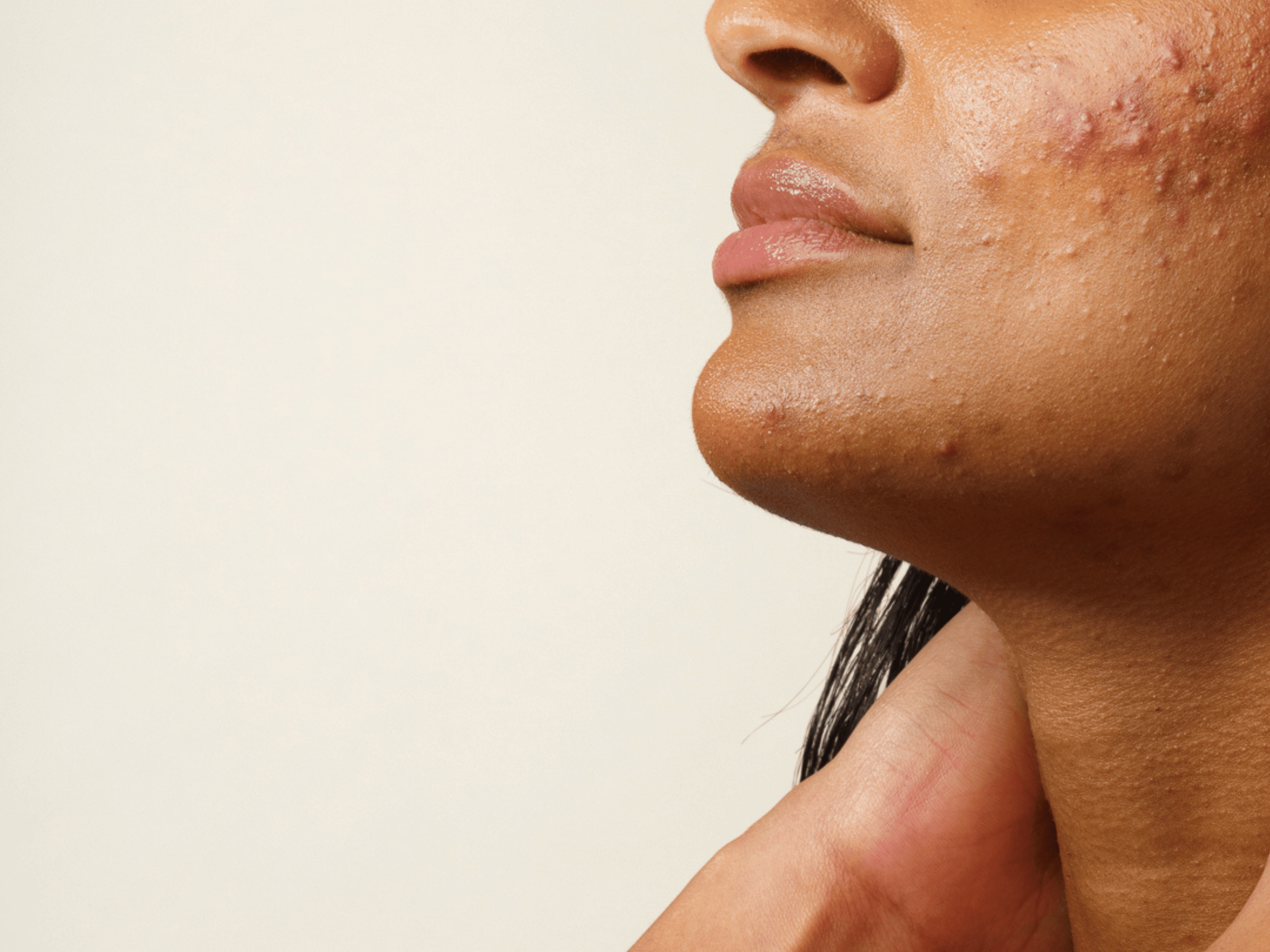 Interview avec Cécile Verdier, naturopathe. Cet article a pour but de t'aider à mieux comprendre les facteurs déclencheurs de l'acné inflammatoire. On te partage également nos conseils afin de l'atténuer.