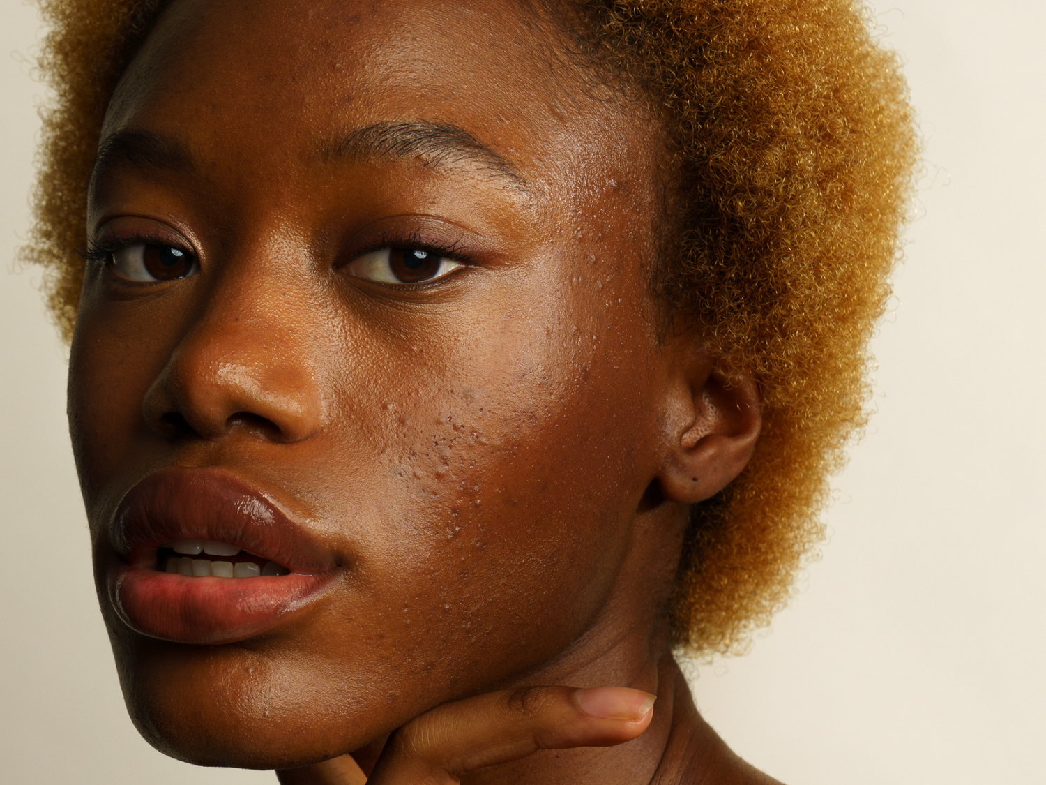 Skin & Out - Solution globale et naturelle pour l'acné